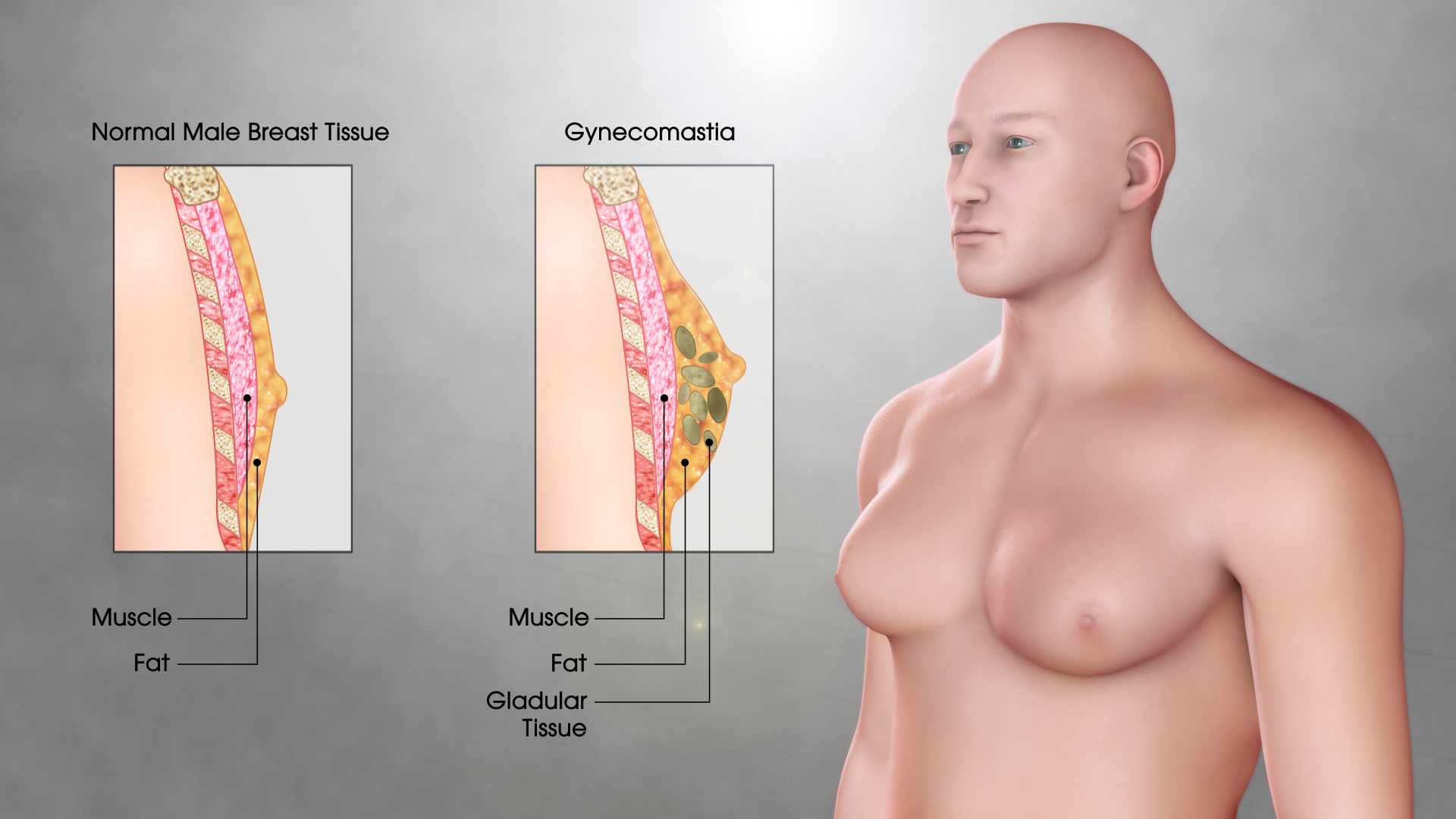 Gynecomastia Surgery – Restoring Confidence in Men