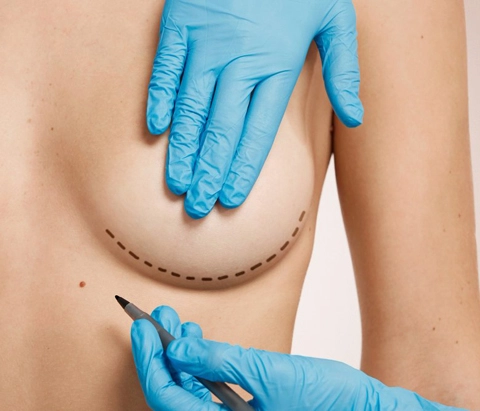Breast Augmentation