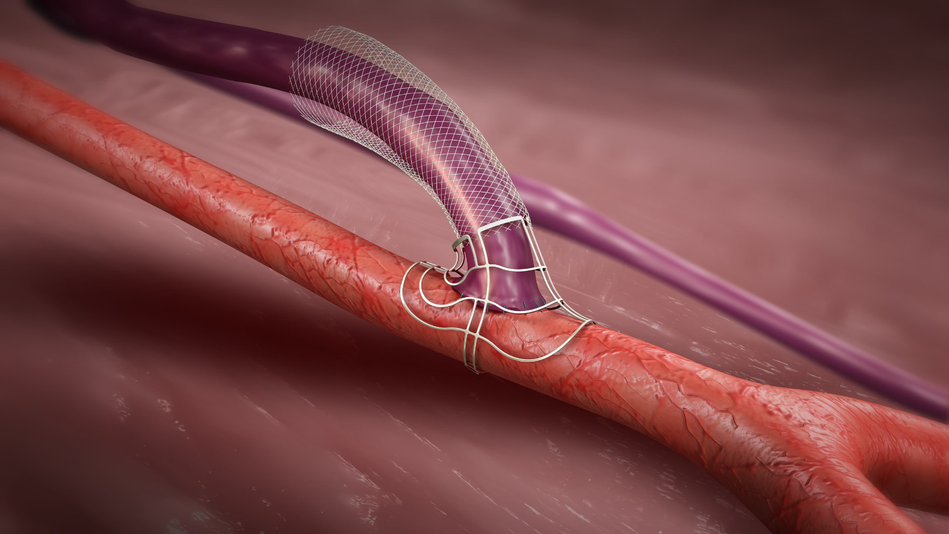 Preparing for AV Fistula Surgery: What Every Dialysis Patient Should Know