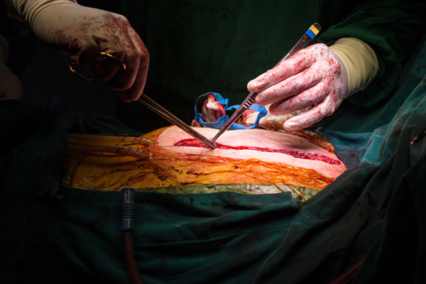 Post Bypass Surgery Wound Dehiscence