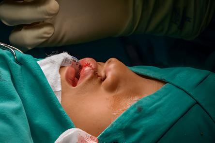 Cleft Lip and Palate and Congenital Anomalies