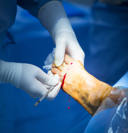 Diabetic Foot Surgery