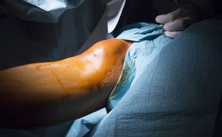 Post Traumatic Lower Limb Surgery
