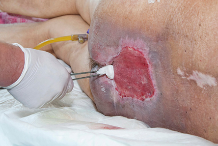 Bed Sore Surgery