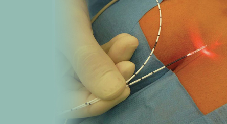 Pilonidal Sinus Surgery
