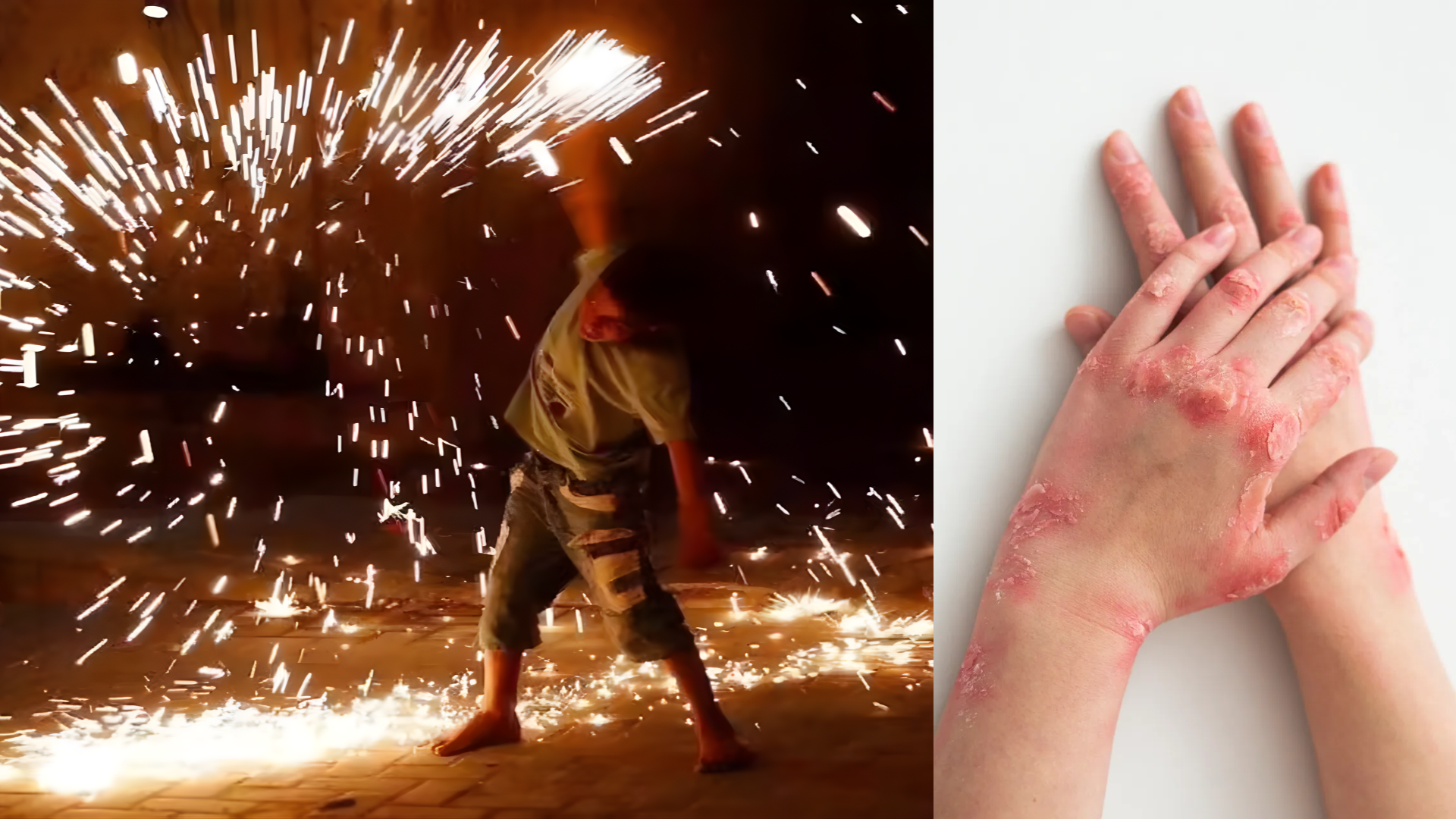 The Diwali burn scar was worse than you expected? Here’s how we can make it go away